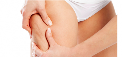 Cellulite su coscia