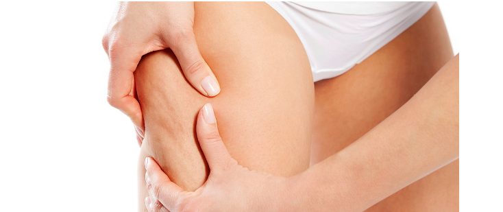 Cellulite su coscia