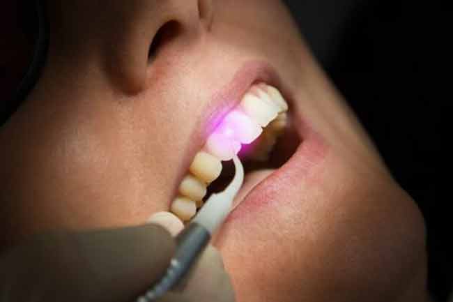 laser-dentale